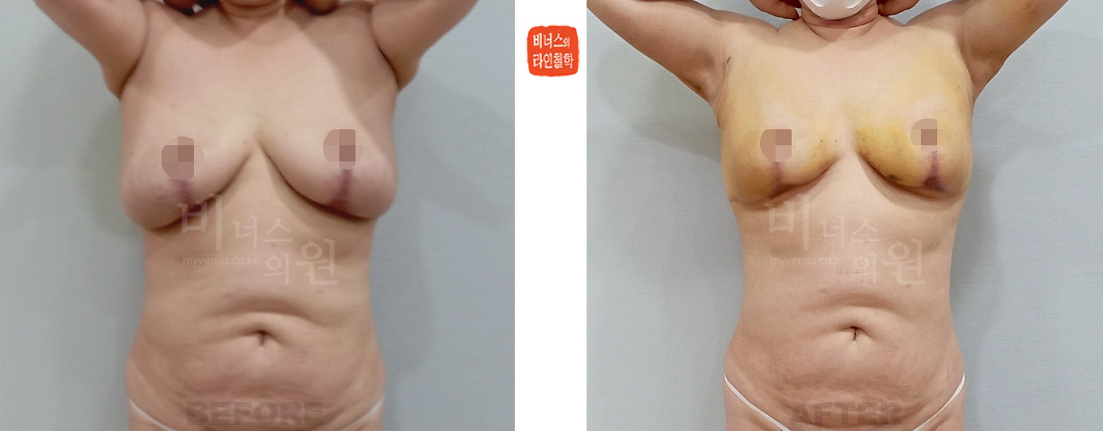 Before-and-after photos of breast reduction liposuction after excisional breast reduction, front (1 week after surgery)