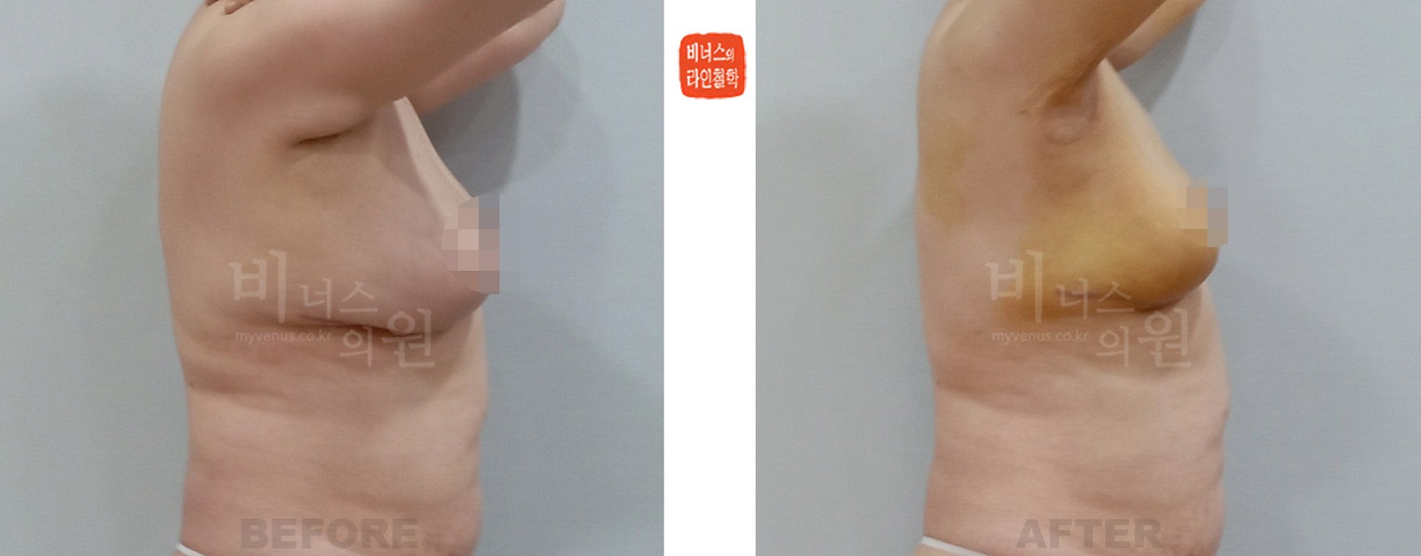 Before-and-after photos of breast reduction liposuction after excisional breast reduction, right side (1 week after surgery)