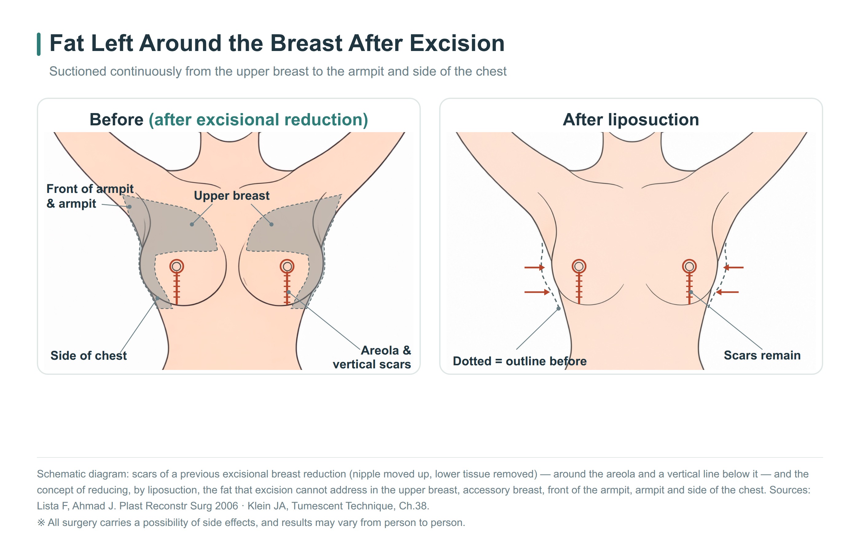 Schematic diagram showing the vertical scar from excisional breast reduction and the areas reduced with liposuction: upper part of the breast, accessory breast, front of the armpit, and side of the chest
