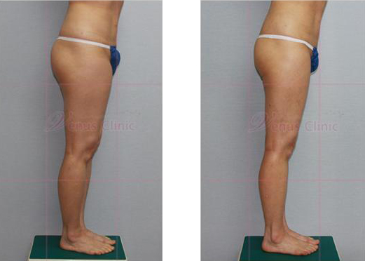 Buttock liposuction before and after photo 3