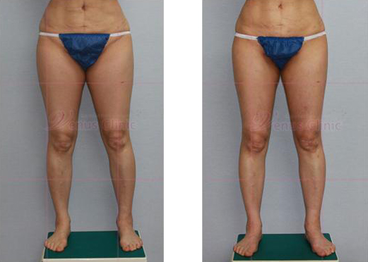 Buttock liposuction before and after photo 1