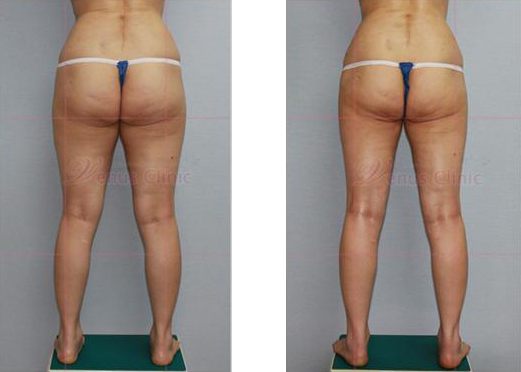 Buttock liposuction before and after photo 2