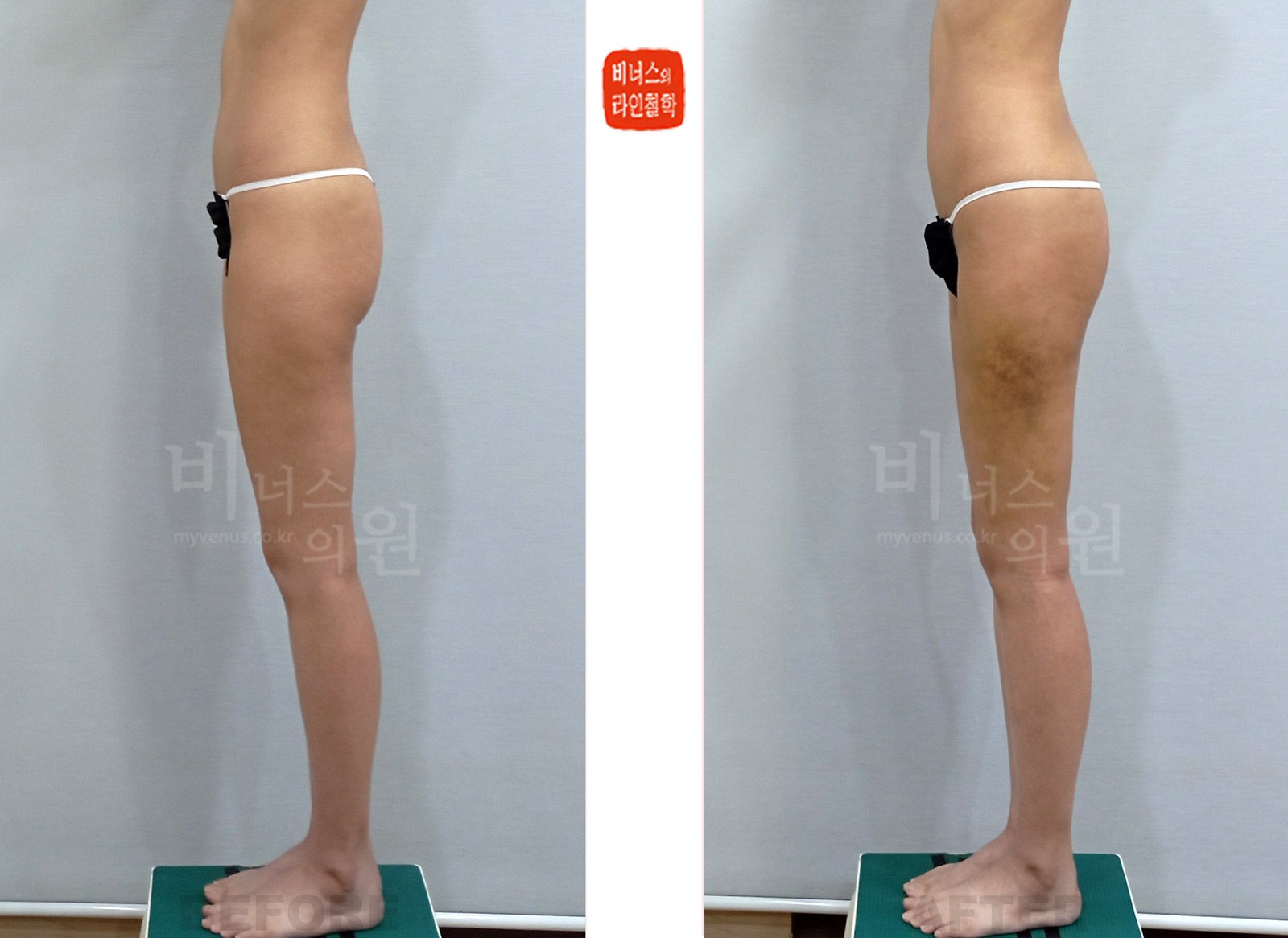 Thigh and buttock liposuction before-and-after photo, side view (1 week after surgery)