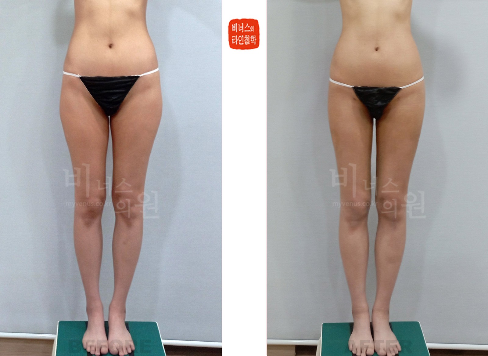 Thigh and buttock liposuction before-and-after photo, front view (1 week after surgery)