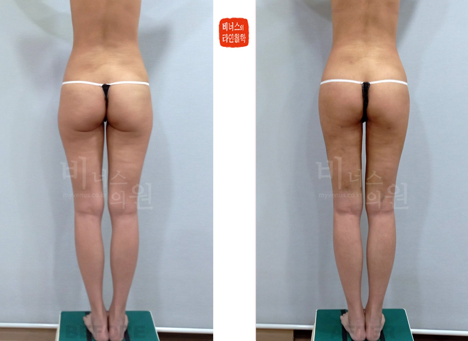 Thigh and buttock liposuction before-and-after photo, rear view (1 week after surgery)