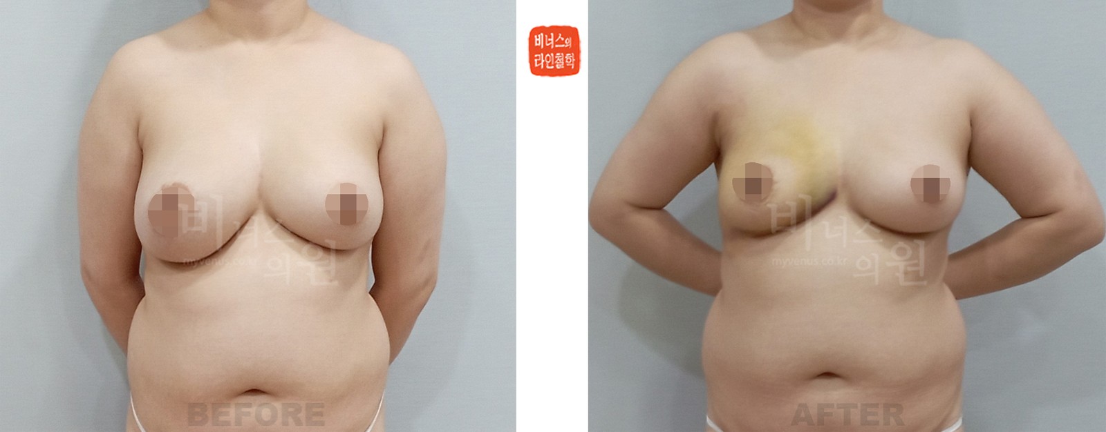 Before-and-after photos of liposuction for breast asymmetry, case 1 (one week after surgery)
