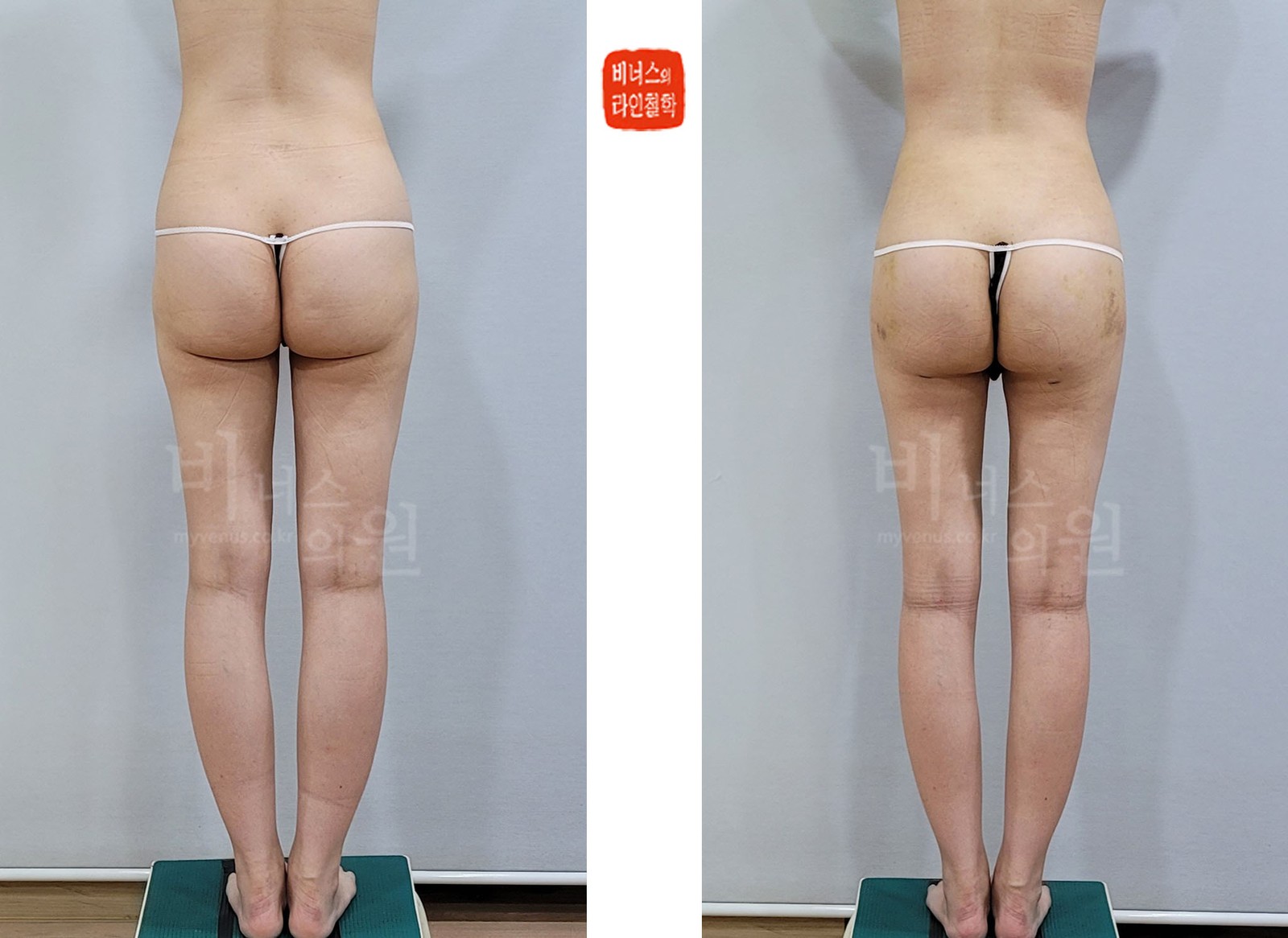 Before-and-after photos of buttock, hip, and lower back liposuction, back view (1 week after surgery)