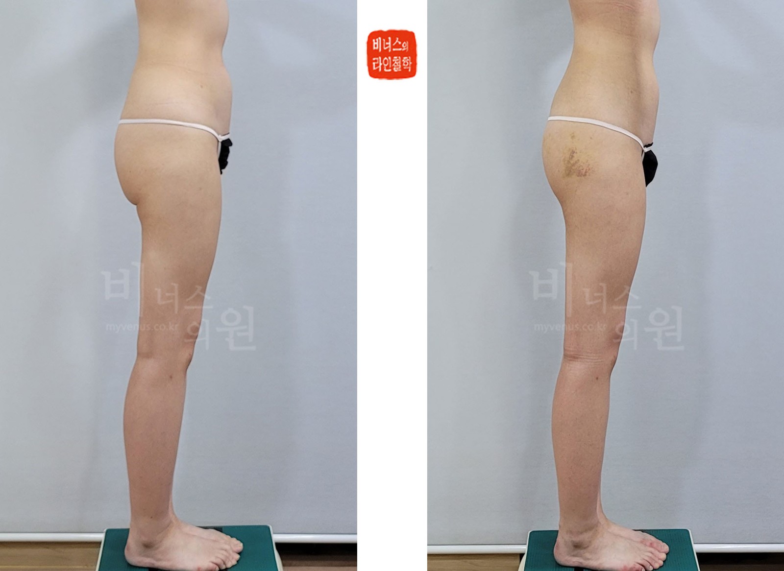 Before-and-after photos of buttock, hip, and lower back liposuction, right side view (1 week after surgery)