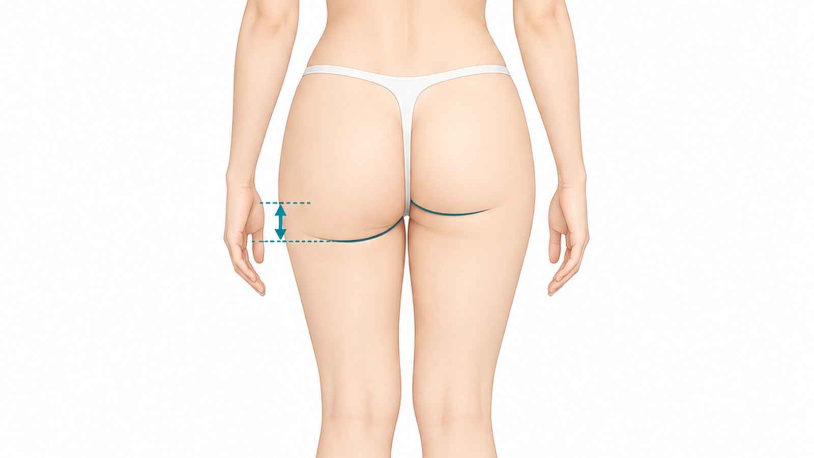 Differences in height and length of the left and right infragluteal folds