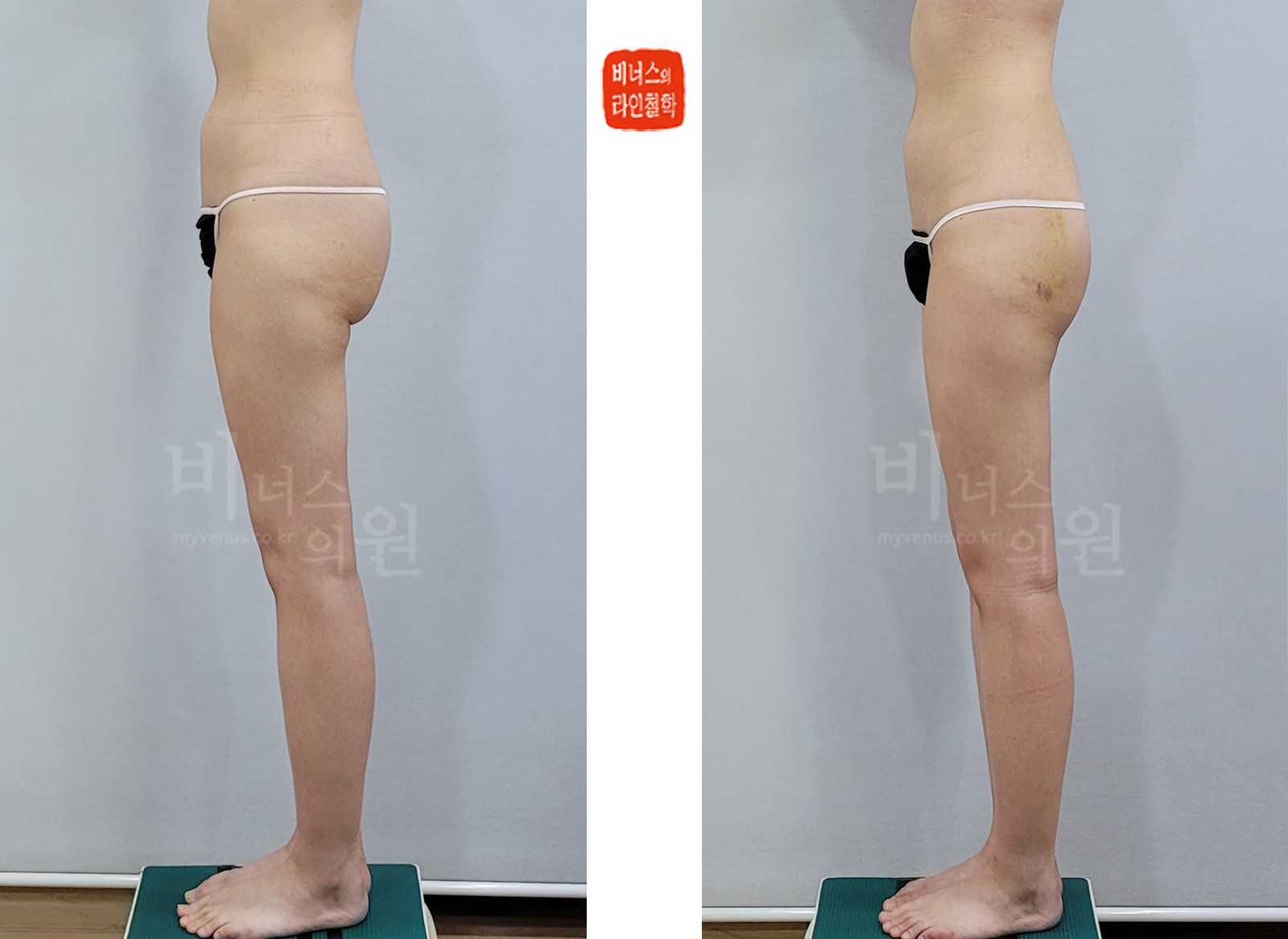 Before-and-after photos of buttock, hip, and lower back liposuction, left side view (1 week after surgery)