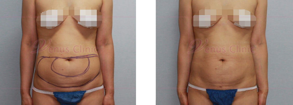 Abdominal mini liposuction photo 1