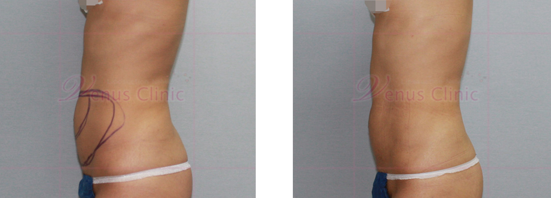 Abdominal mini liposuction photo 2