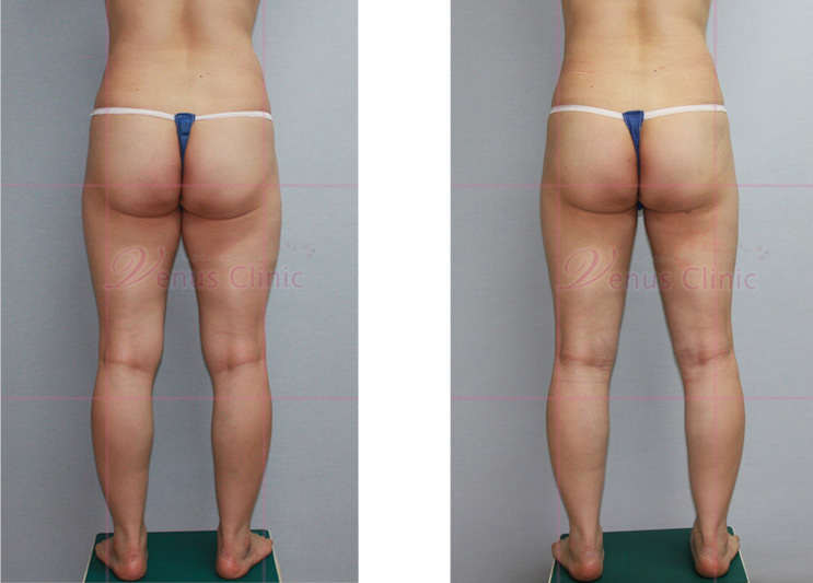 Before and after liposuction photo 1