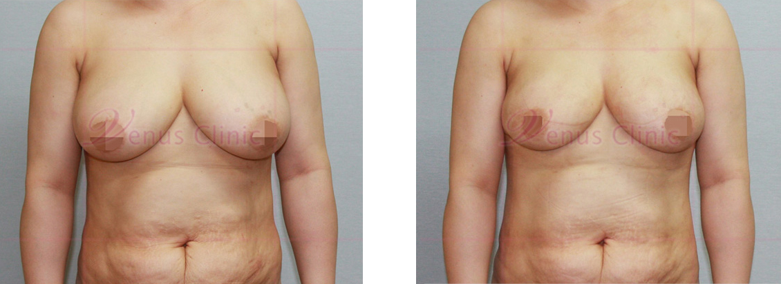 Before and after breast reduction liposuction