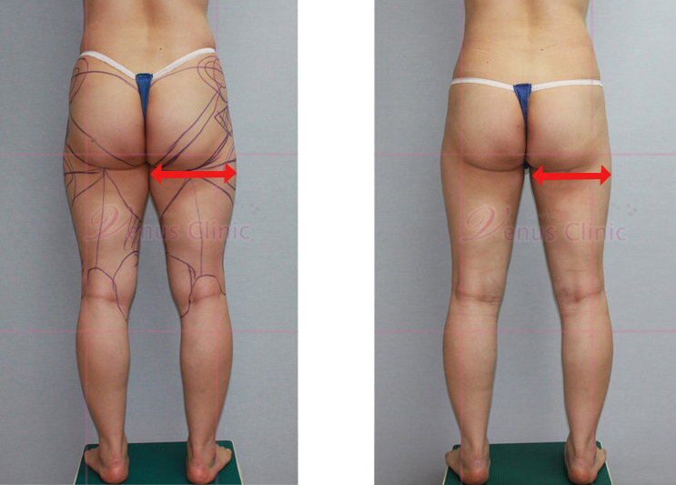 Measuring size before and after liposuction