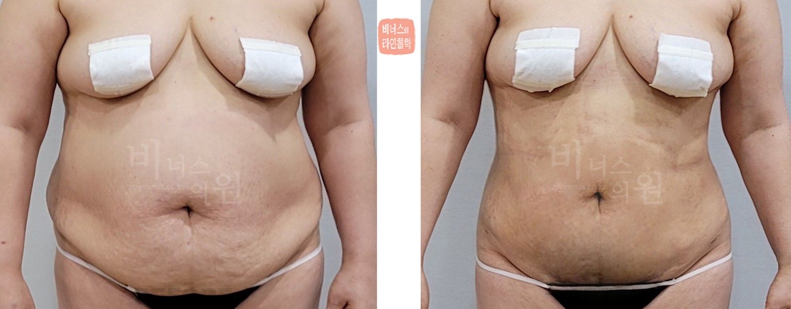 Before-and-after liposuction photo of a sagging abdomen, front view (12 days after surgery)