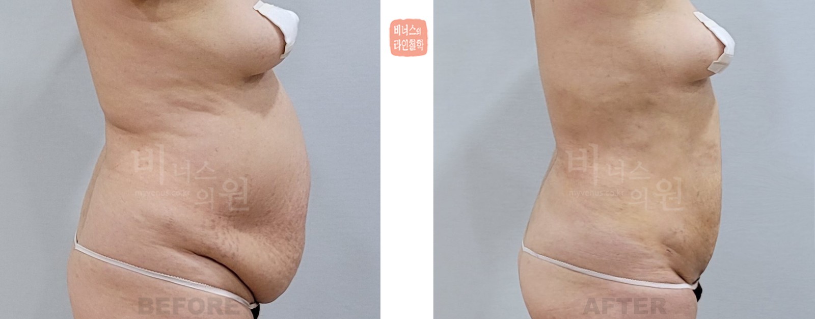 Before-and-after liposuction photo of a sagging abdomen, right side view (12 days after surgery)
