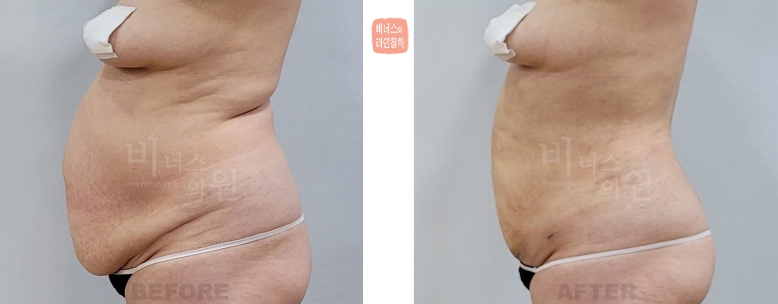 Before-and-after liposuction photo of a sagging abdomen, left side view (12 days after surgery)