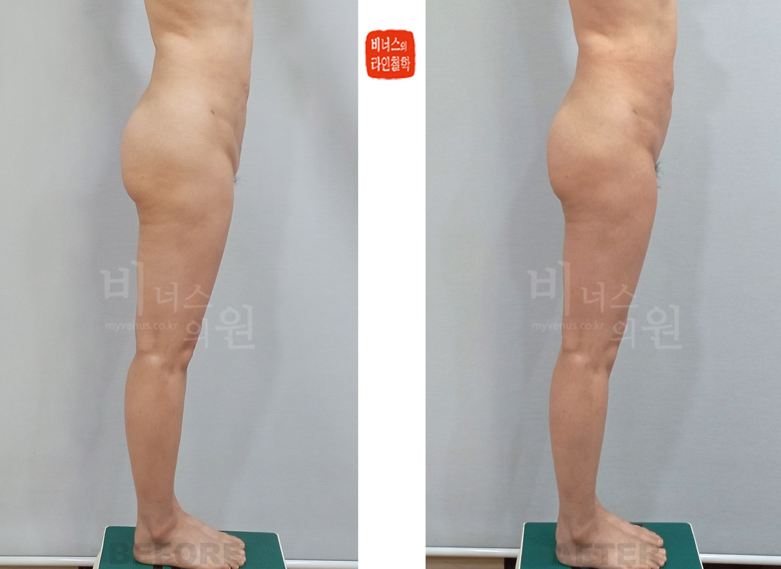 Before-and-after photos of Y-zone liposuction for disharmonious obesity, Case 2, side view (1 week after surgery)