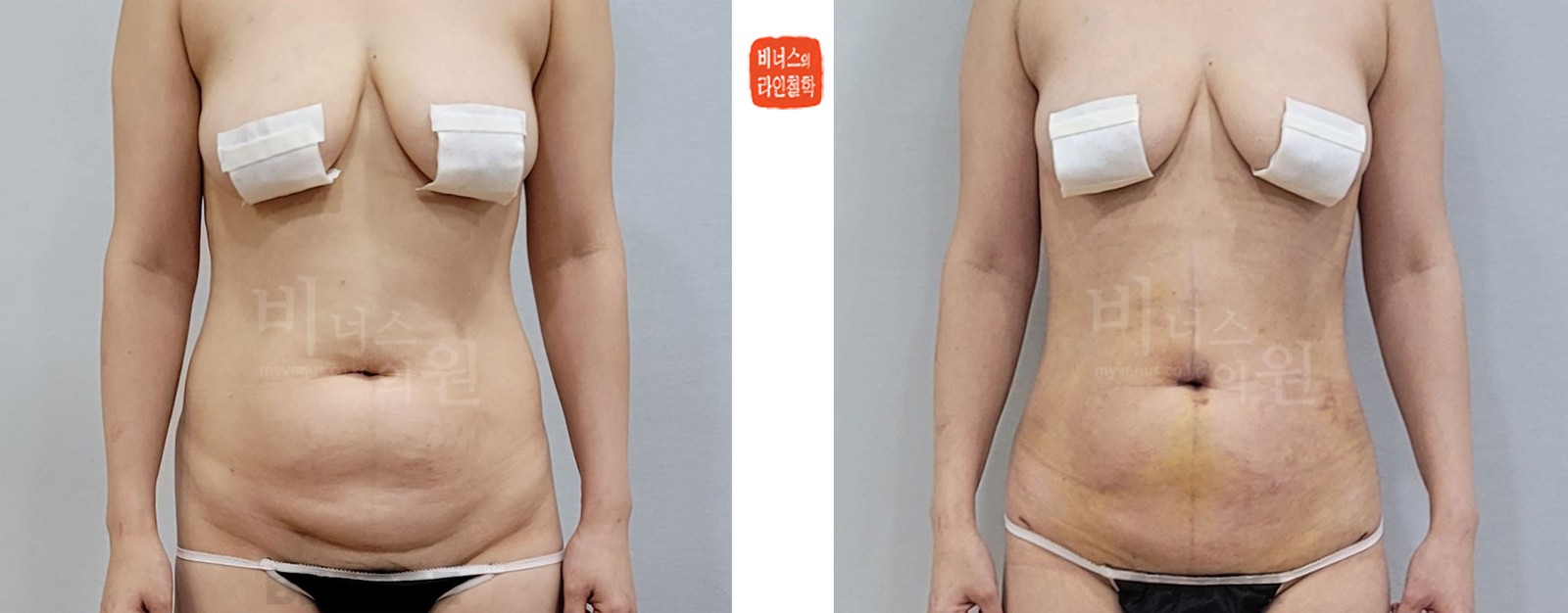 Before-and-after photos of abdominal revision surgery combined with Y-zone liposuction, Case 3, front view (1 week after surgery)