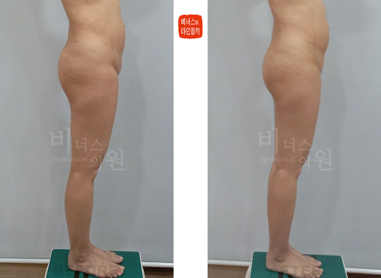 Before-and-after photos of Y-zone liposuction for disharmonious obesity, Case 1, side view (1 week after surgery)