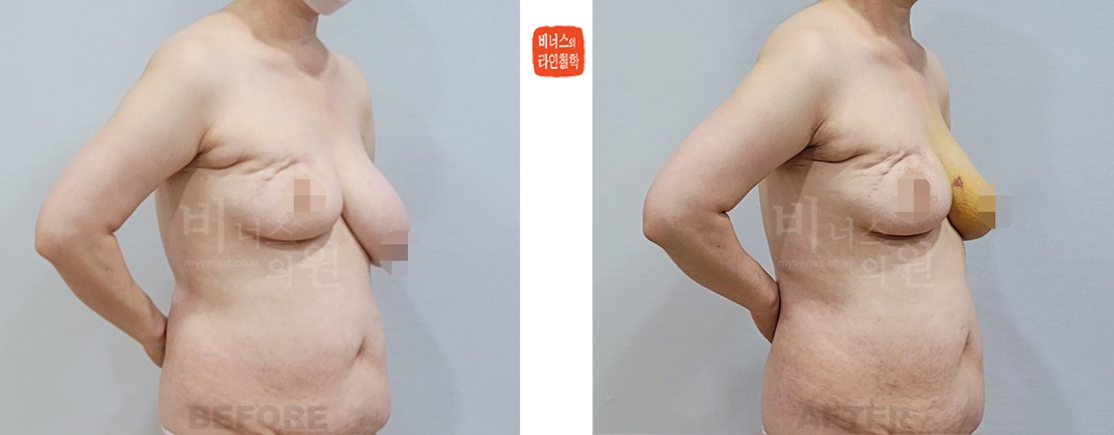 Before-and-after photo, side view, breast reduction liposuction for asymmetry after breast cancer surgery (1 week after surgery)
