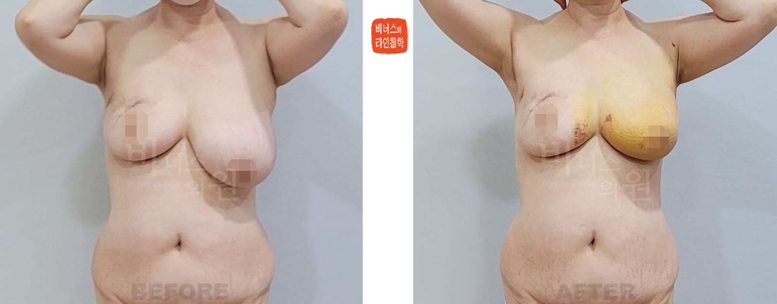 Before-and-after photo, front view, breast reduction liposuction for asymmetry after breast cancer surgery (1 week after surgery)