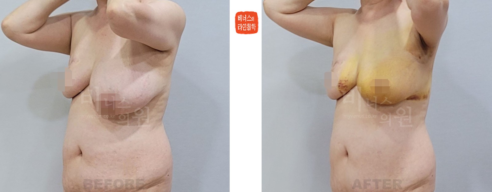 Before-and-after photo, oblique view, breast reduction liposuction for asymmetry after breast cancer surgery (1 week after surgery)