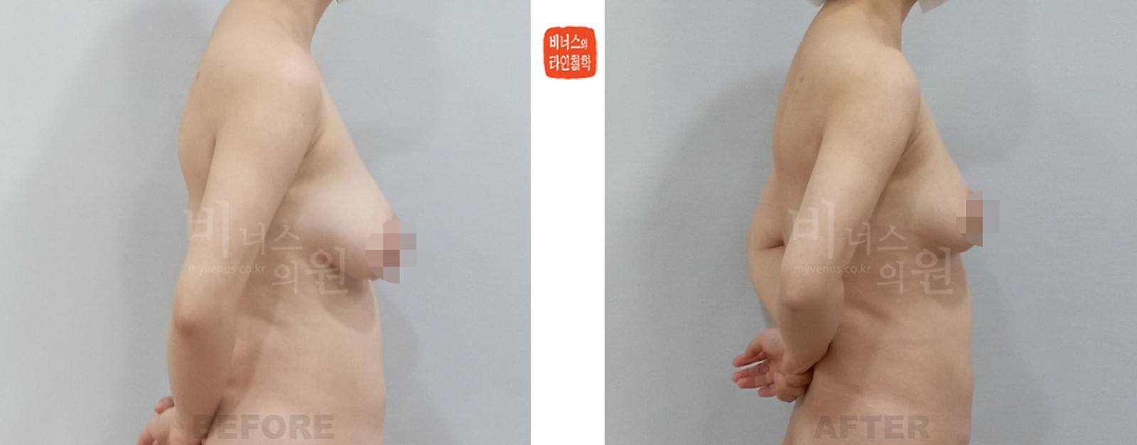 Before-and-after photos of liposuction breast reduction for sagging breasts after childbirth, side view (1 week after surgery)