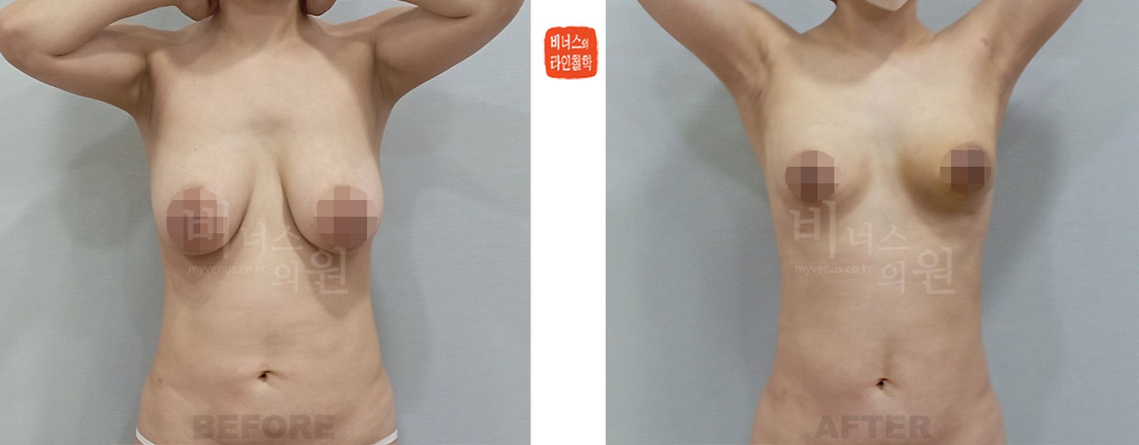 Before-and-after photos of liposuction breast reduction for sagging breasts after childbirth, front view (1 week after surgery)