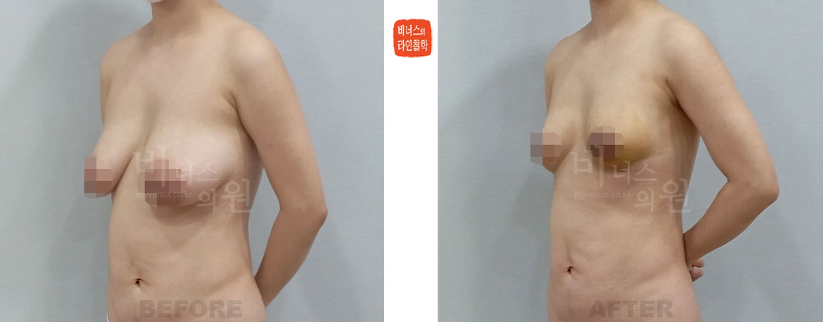 Before-and-after photos of liposuction breast reduction for sagging breasts after childbirth, oblique view (1 week after surgery)