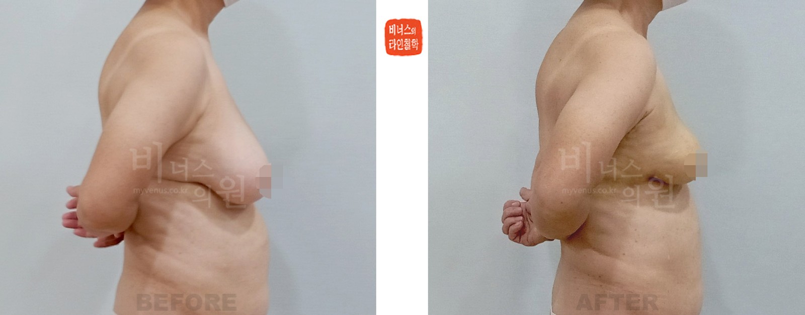 Before-and-after photo of liposuction for breast asymmetry after breast cancer surgery, right side view (1 week after surgery)