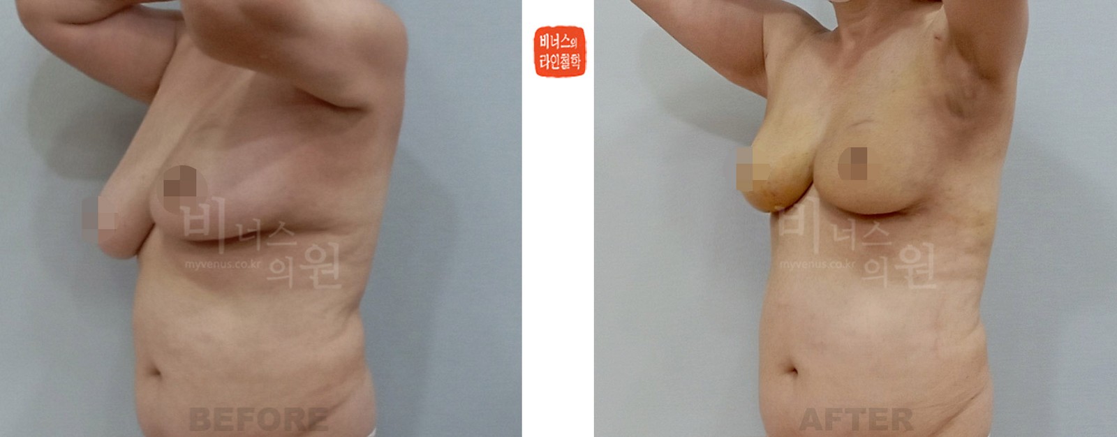 Before-and-after photo of liposuction for breast asymmetry after breast cancer surgery, left oblique view (1 week after surgery)