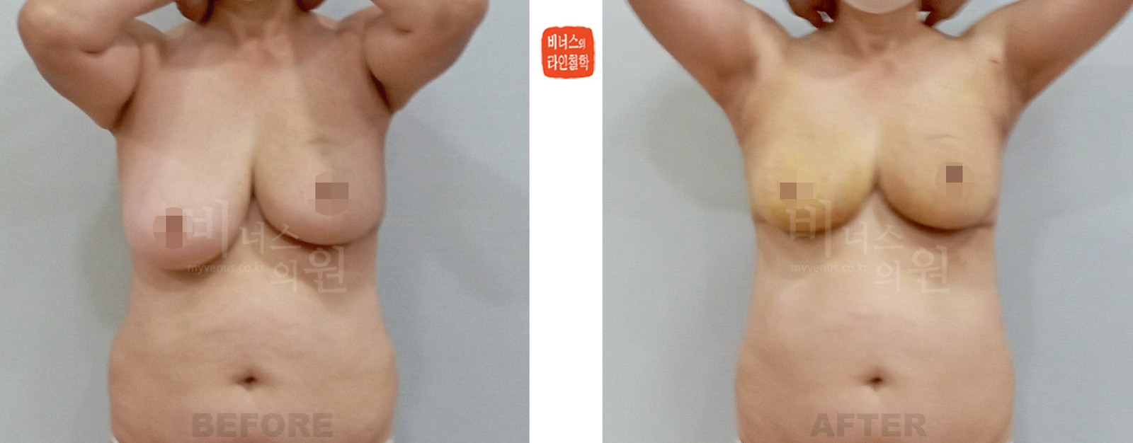 Before-and-after photo of liposuction for breast asymmetry after breast cancer surgery, front view (1 week after surgery)