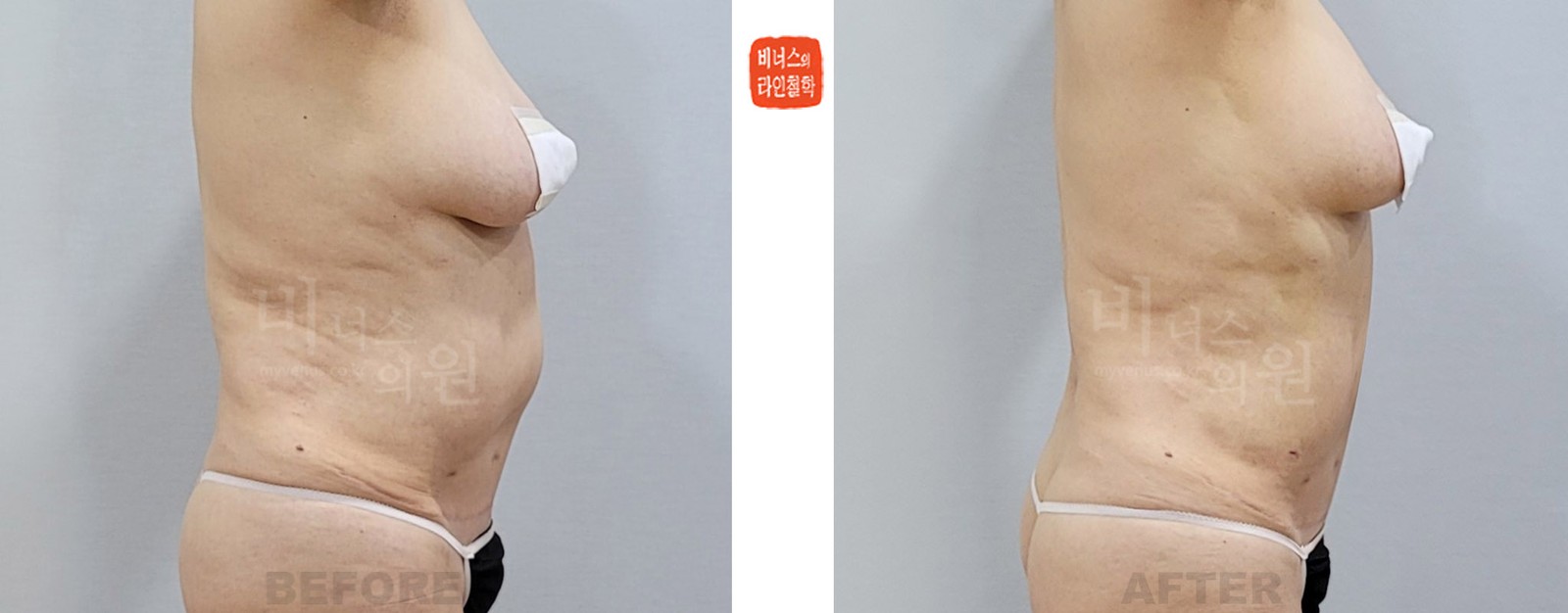 Revision upper abdominal liposuction before-and-after photo, right side view (1 week after surgery)