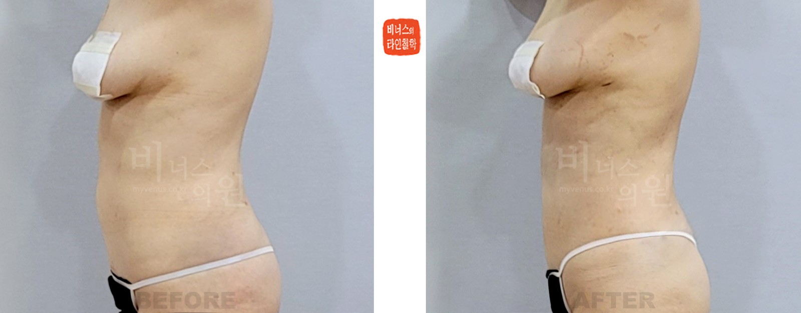 Revision upper abdominal liposuction, Case 2 before-and-after photo, left side view (1 week after surgery)