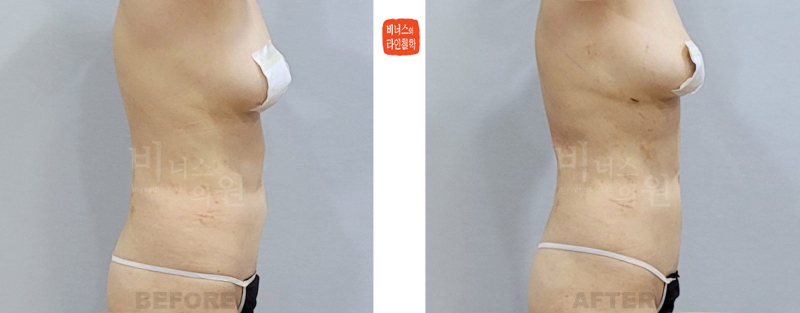 Revision upper abdominal liposuction, Case 2 before-and-after photo, right side view (1 week after surgery)