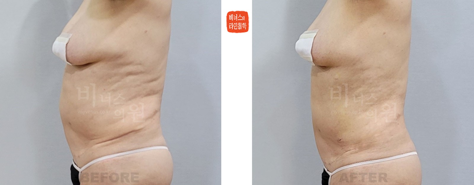 Revision upper abdominal liposuction before-and-after photo, left side view (1 week after surgery)