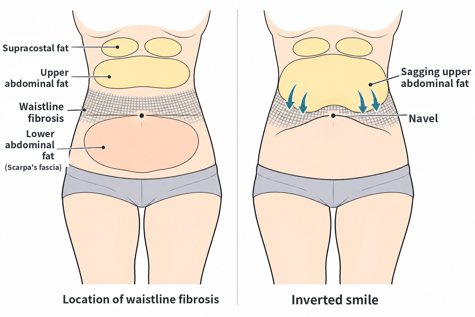 Diagram showing the location of waistline fibrosis and how the inverted smile shape forms