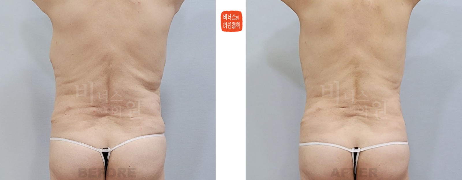Revision upper abdominal liposuction before-and-after photo, back view (1 week after surgery)