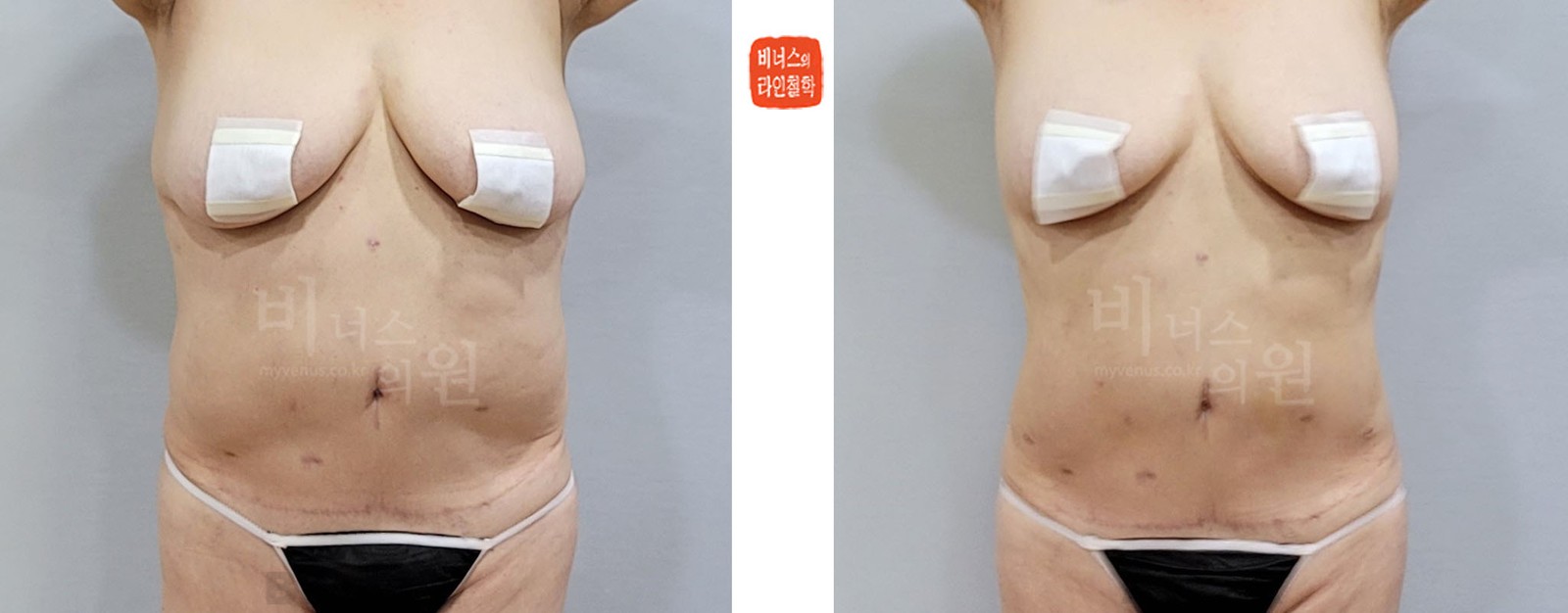 Revision upper abdominal liposuction before-and-after photo, front view (1 week after surgery)