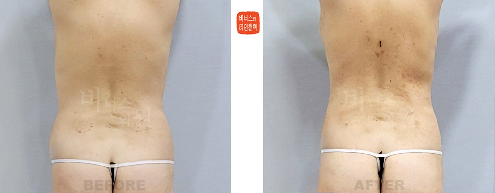 Revision upper abdominal liposuction, Case 2 before-and-after photo, back view (1 week after surgery)