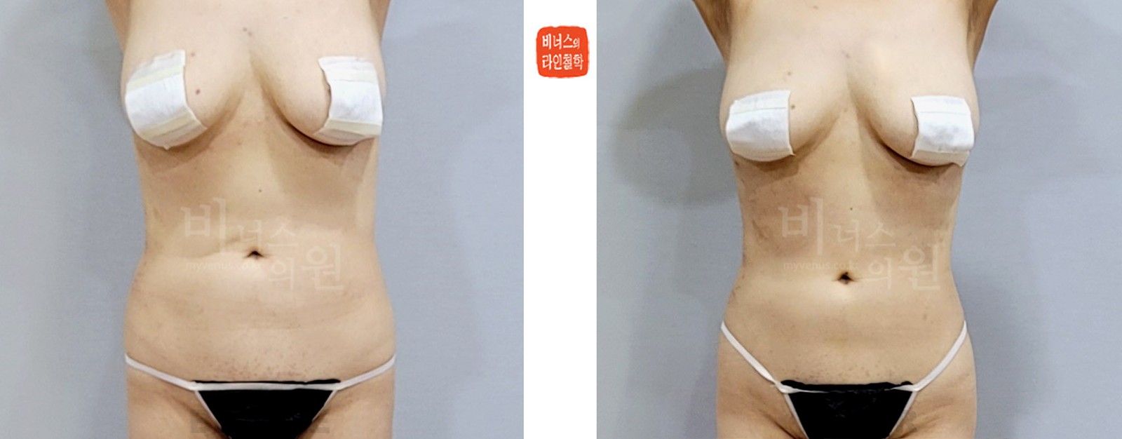 Revision upper abdominal liposuction, Case 2 before-and-after photo, front view (1 week after surgery)