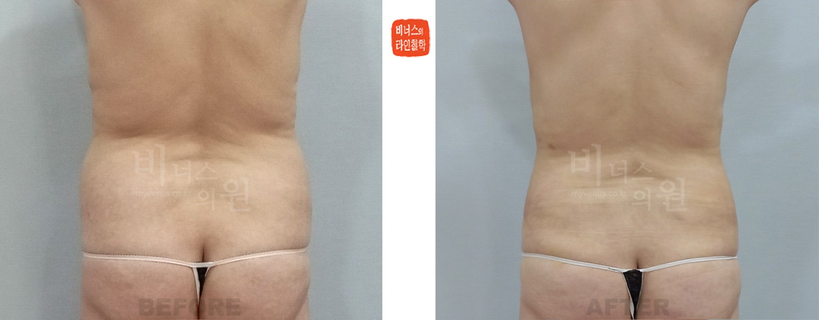 360-degree cylindrical hourglass abdomen liposuction, before and after, back view (1 week after surgery)