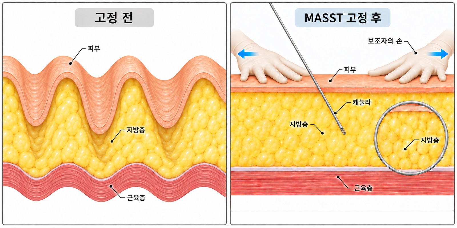MASST cross-section diagram: an assistant flattens and holds a curtain-like rippled fat layer by hand