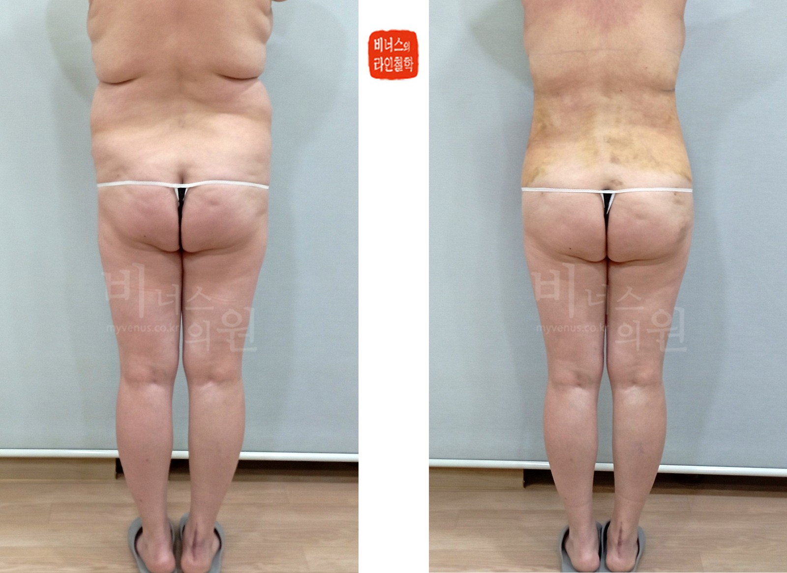 Circumferential liposuction for a sagging abdomen, before and after, back view (1 week after surgery)