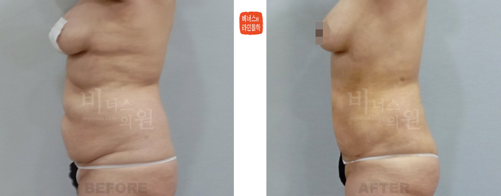 360-degree cylindrical hourglass abdomen liposuction, before and after, side view (1 week after surgery)