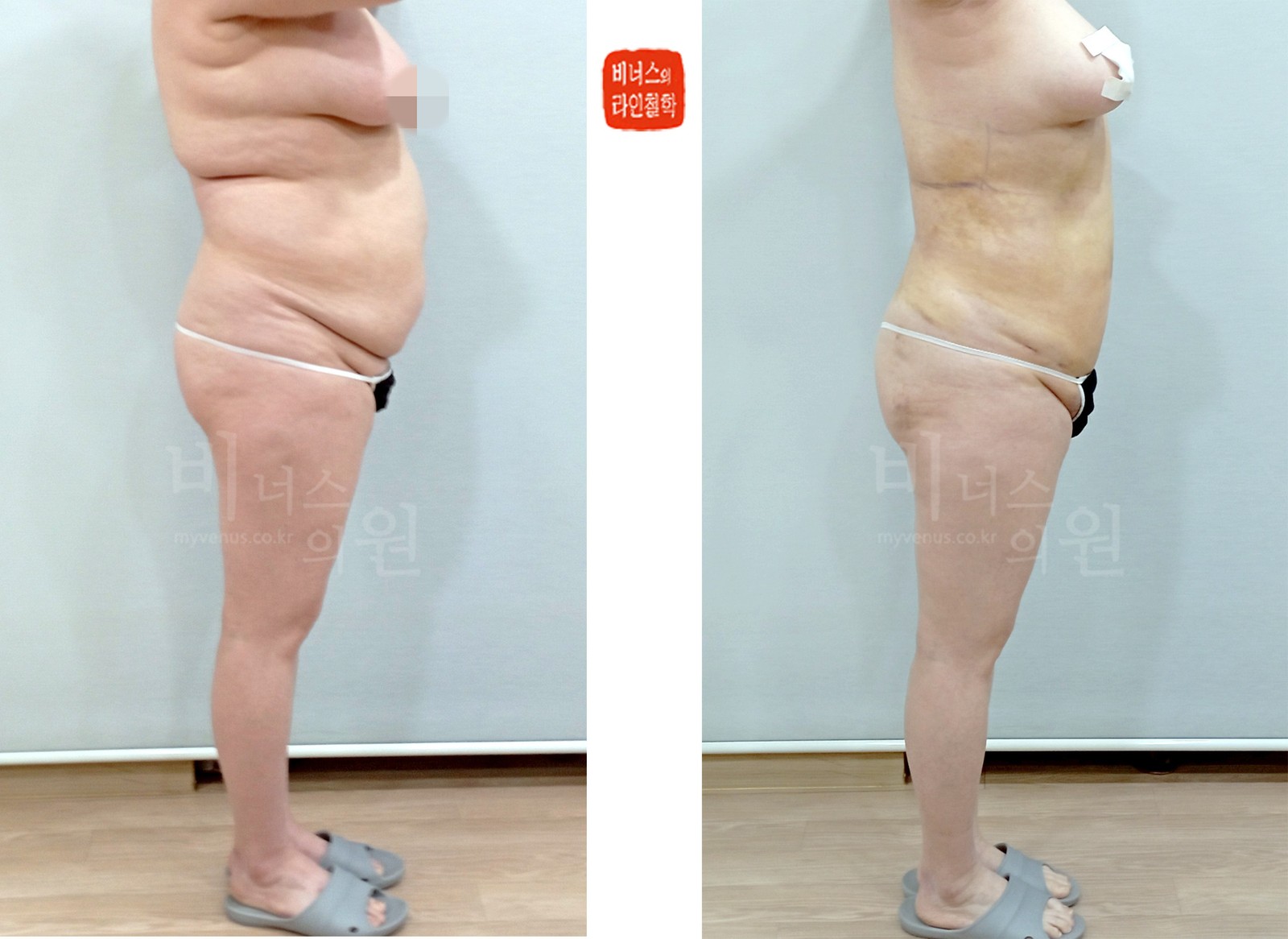 Circumferential liposuction for a sagging abdomen, before and after, side view 2 (1 week after surgery)