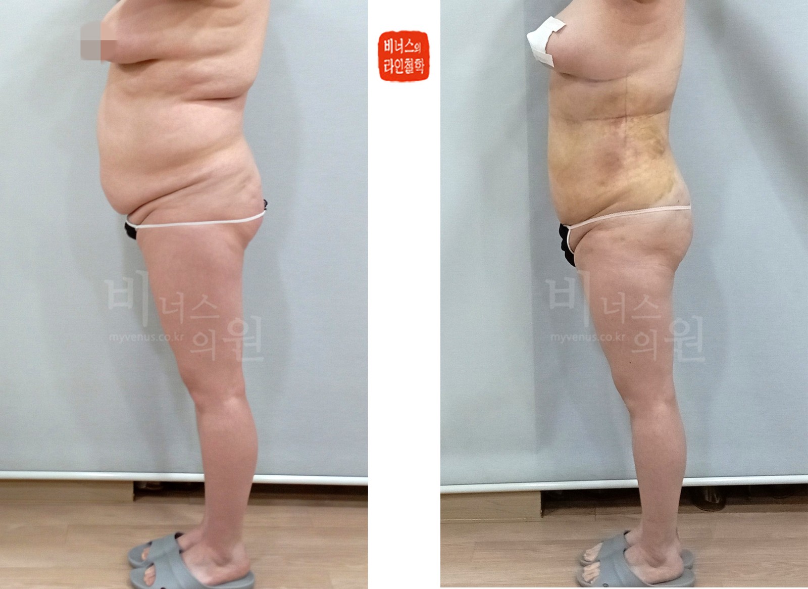 Circumferential liposuction for a sagging abdomen, before and after, side view 1 (1 week after surgery)