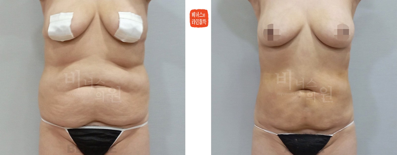 360-degree cylindrical hourglass abdomen liposuction, before and after, front view (1 week after surgery)